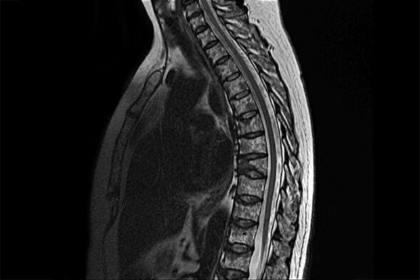 Krūtinės ląstos osteochondrozės apraiškos MRT atvaizde