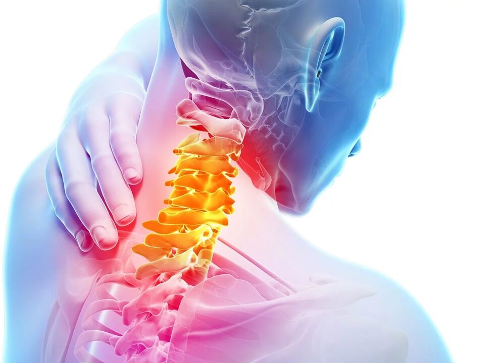 Gimdos kaklelio osteochondrozė