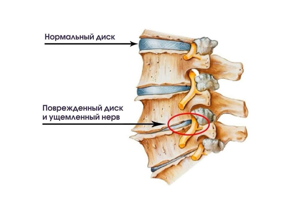 Gimdos kaklelio osteochondrozės simptomai
