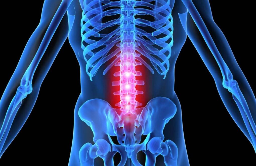 Juosmens stuburo osteochondrozė