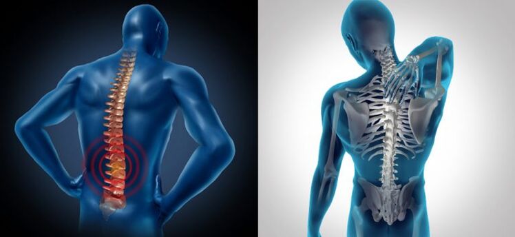 Stuburo osteochondrozės uždegimas