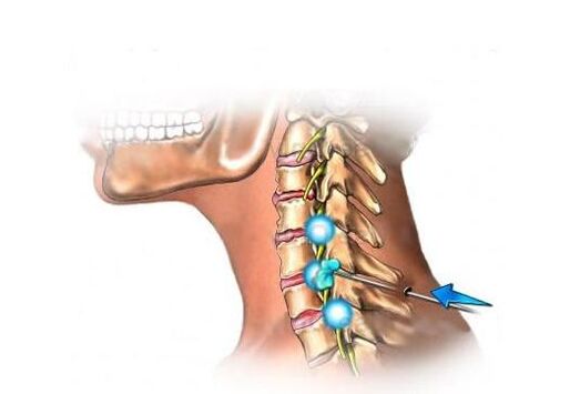 Gimdos kaklelio osteochondrozės gydymas